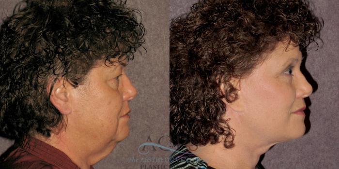 Before & After Neck Lift Case 1237 Side Right View: View in Houston, TX