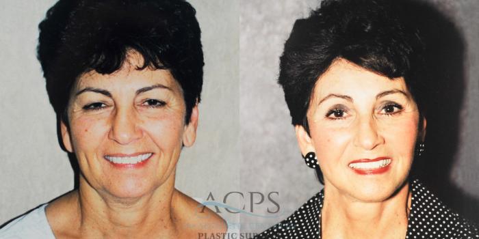 Before & After Neck Lift Case 1238 Front View: View in Houston, TX