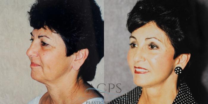 Before & After Neck Lift Case 1238 Oblique Left View: View in Houston, TX