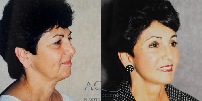 Before & After Neck Lift Case 1238 Oblique Right View: View in Houston, TX