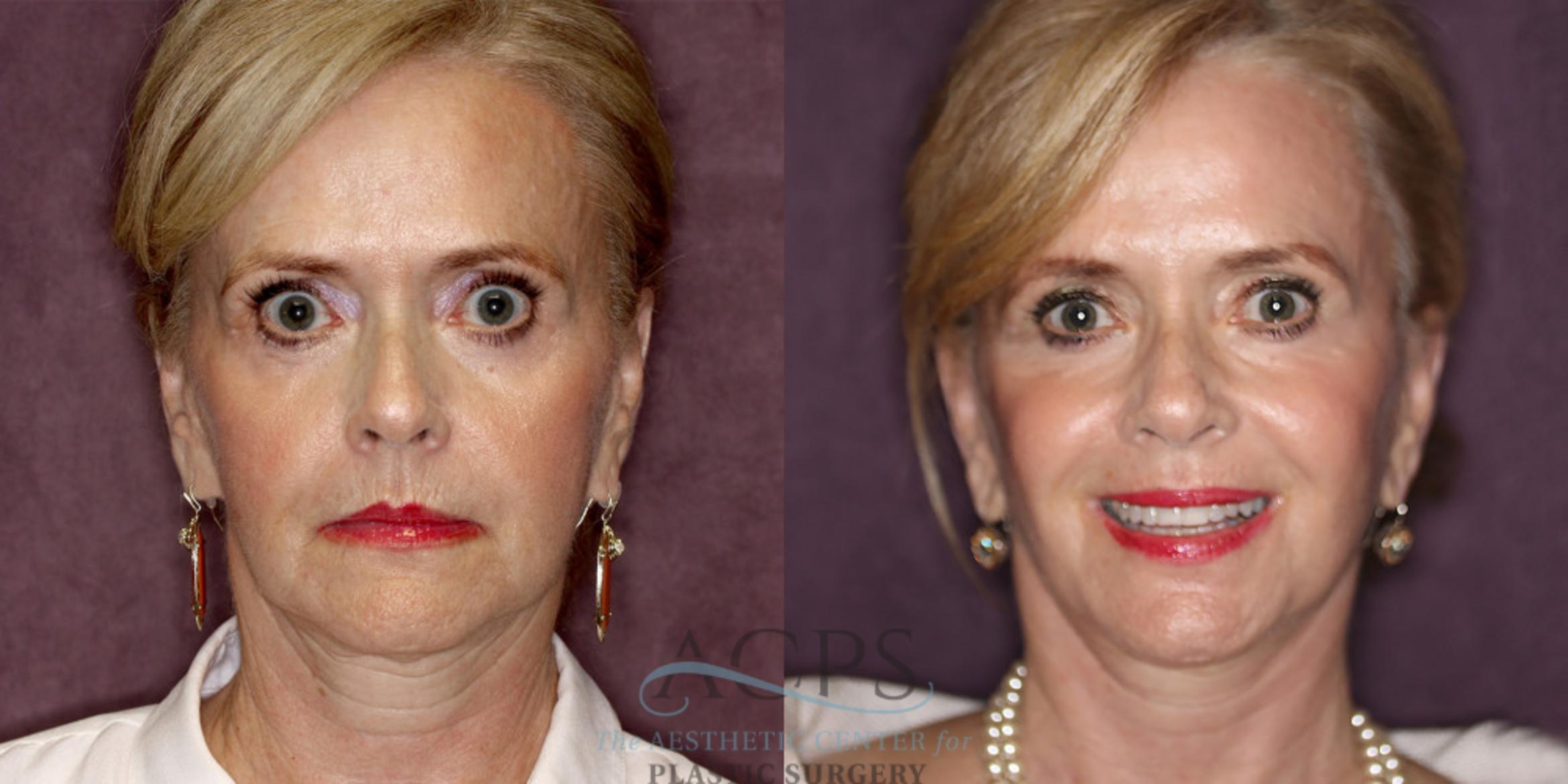 Before & After Facelift Case 1239 Front View: View in Houston, TX