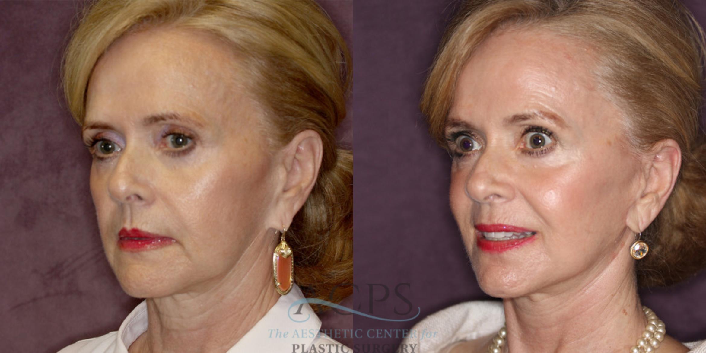 Before & After Facelift Case 1239 Oblique Left View: View in Houston, TX