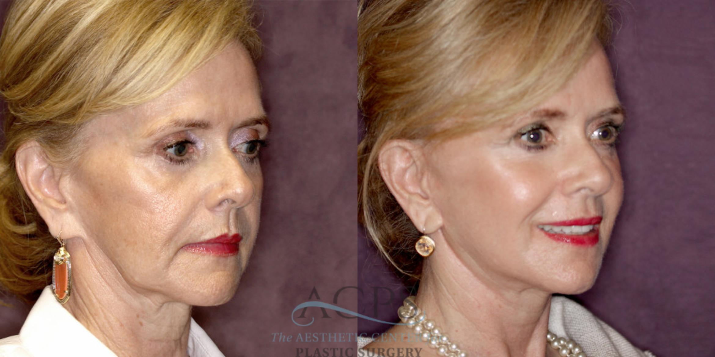 Before & After Facelift Case 1239 Oblique Right View: View in Houston, TX