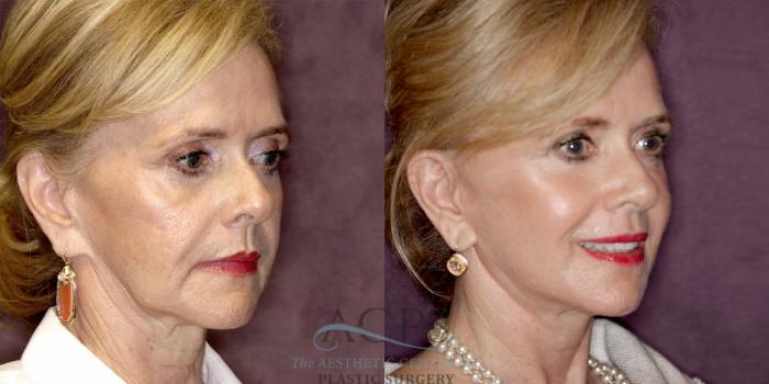 Before & After Facelift Case 1239 Oblique Right View: View in Houston, TX