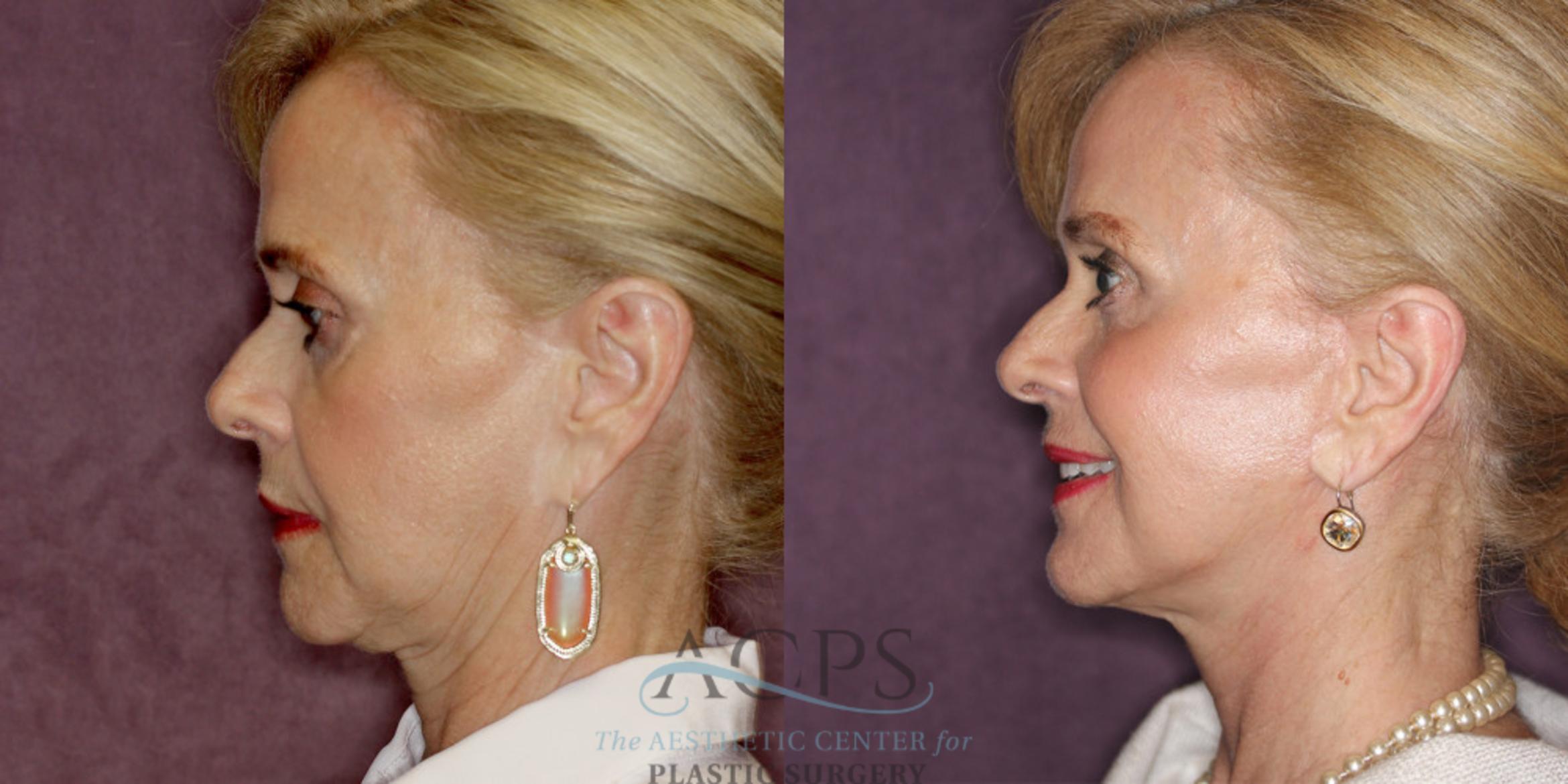 Before & After Facelift Case 1239 Side Left View: View in Houston, TX