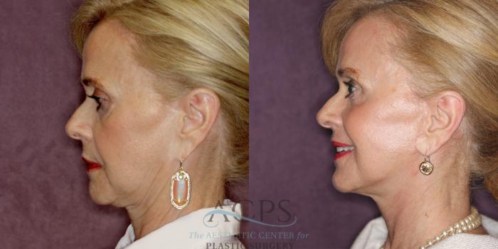 Before & After Facelift Case 1239 Side Left View: View in Houston, TX
