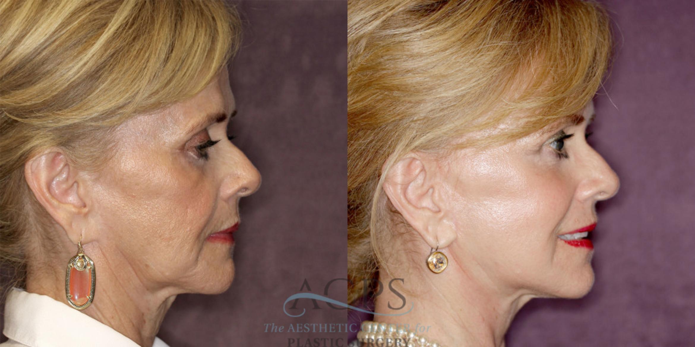 Before & After Facelift Case 1239 Side Right View: View in Houston, TX