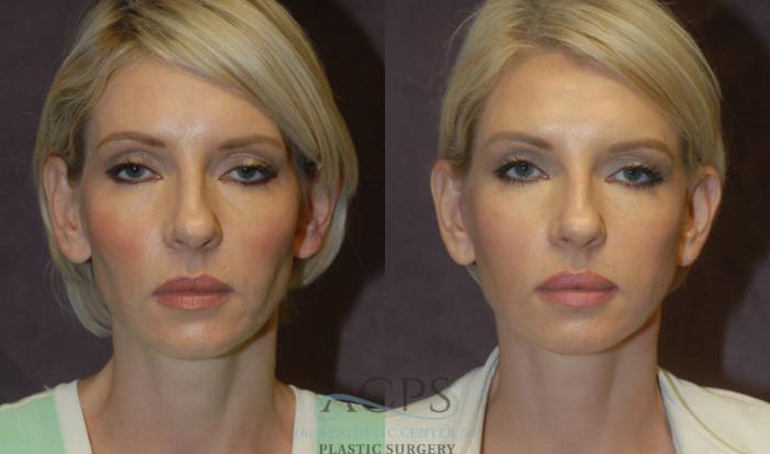 Before & After Neck Lift Case 1240 Front View: View in Houston, TX