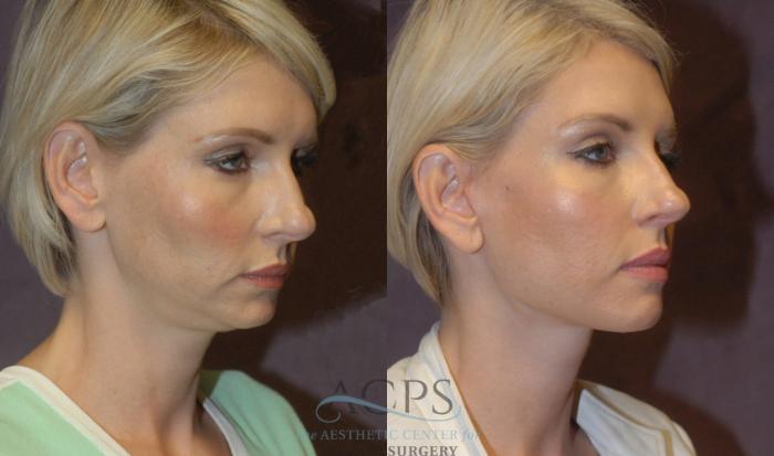 Before & After Neck Lift Case 1240 Oblique View: View in Houston, TX