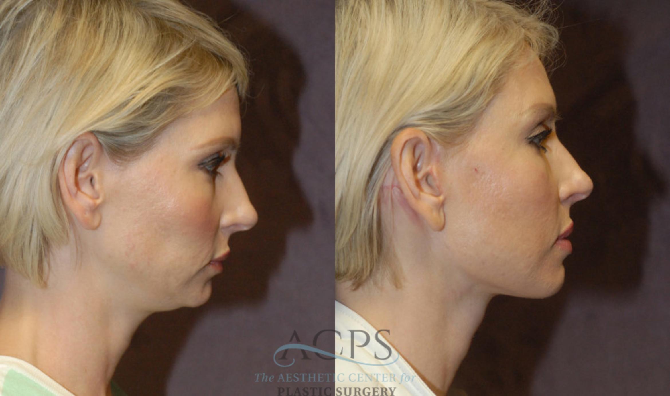 Before & After Neck Lift Case 1240 Side View: View in Houston, TX