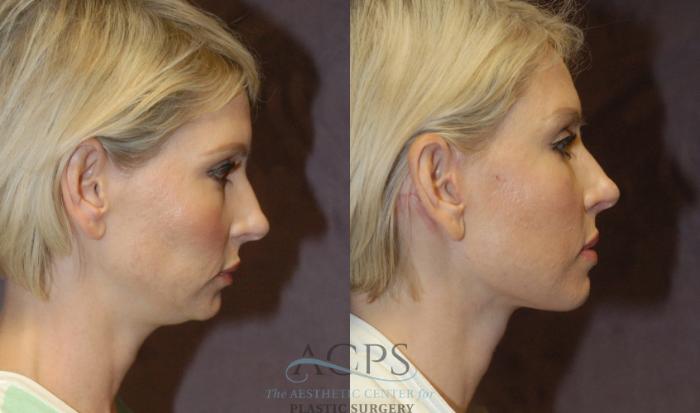 Before & After Neck Lift Case 1240 Side View: View in Houston, TX
