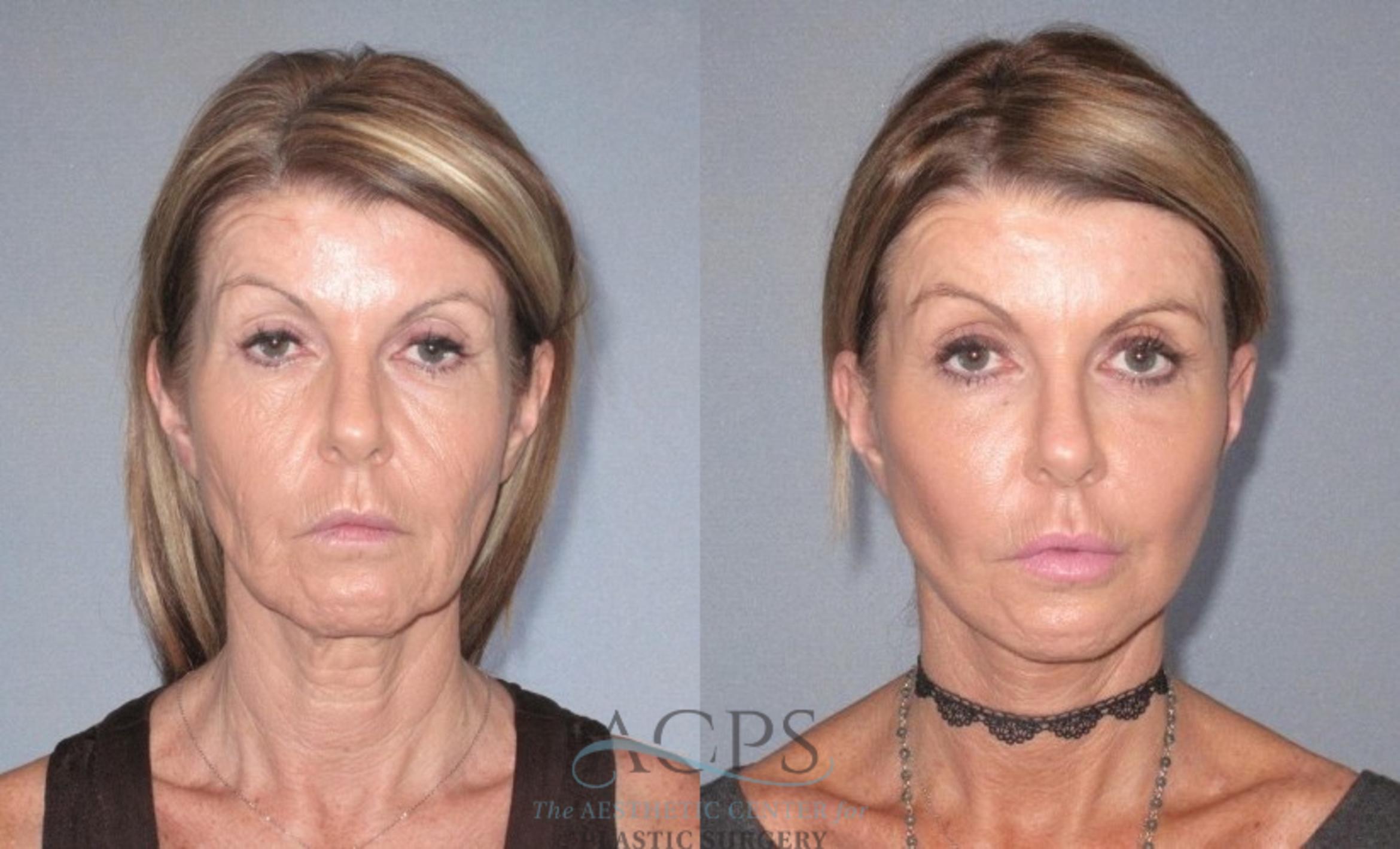 Before & After Facelift Case 1241 Front View: View in Houston, TX