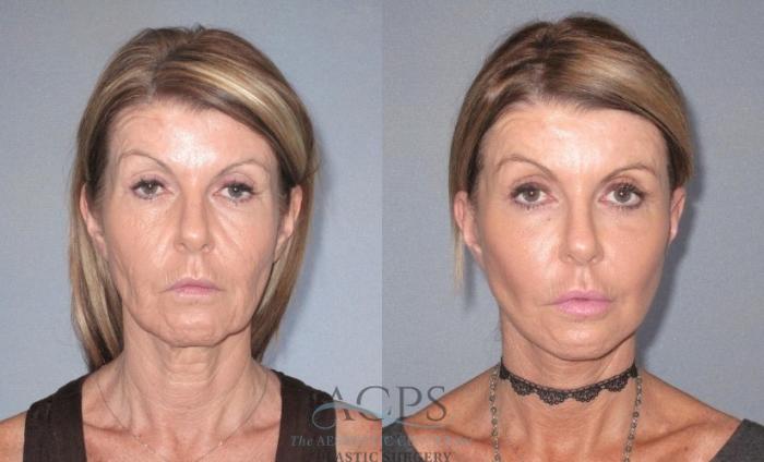 Before & After Neck Lift Case 1241 Front View: View in Houston, TX