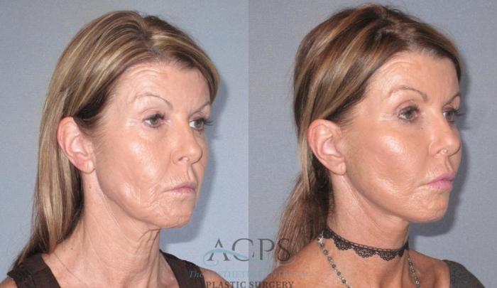 Before & After Neck Lift Case 1241 Oblique View: View in Houston, TX