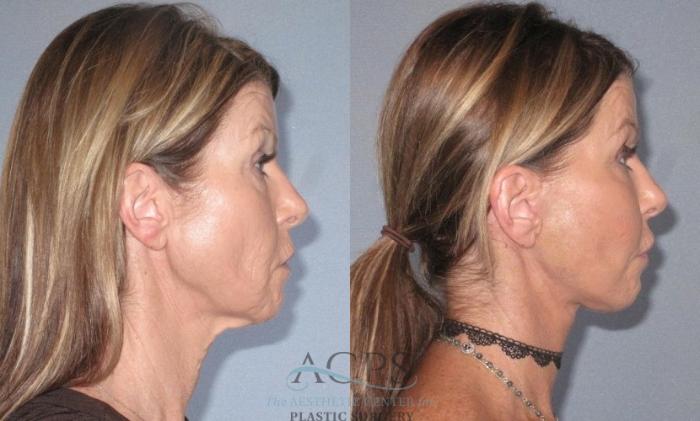 Before & After Neck Lift Case 1241 Side Left View: View in Houston, TX