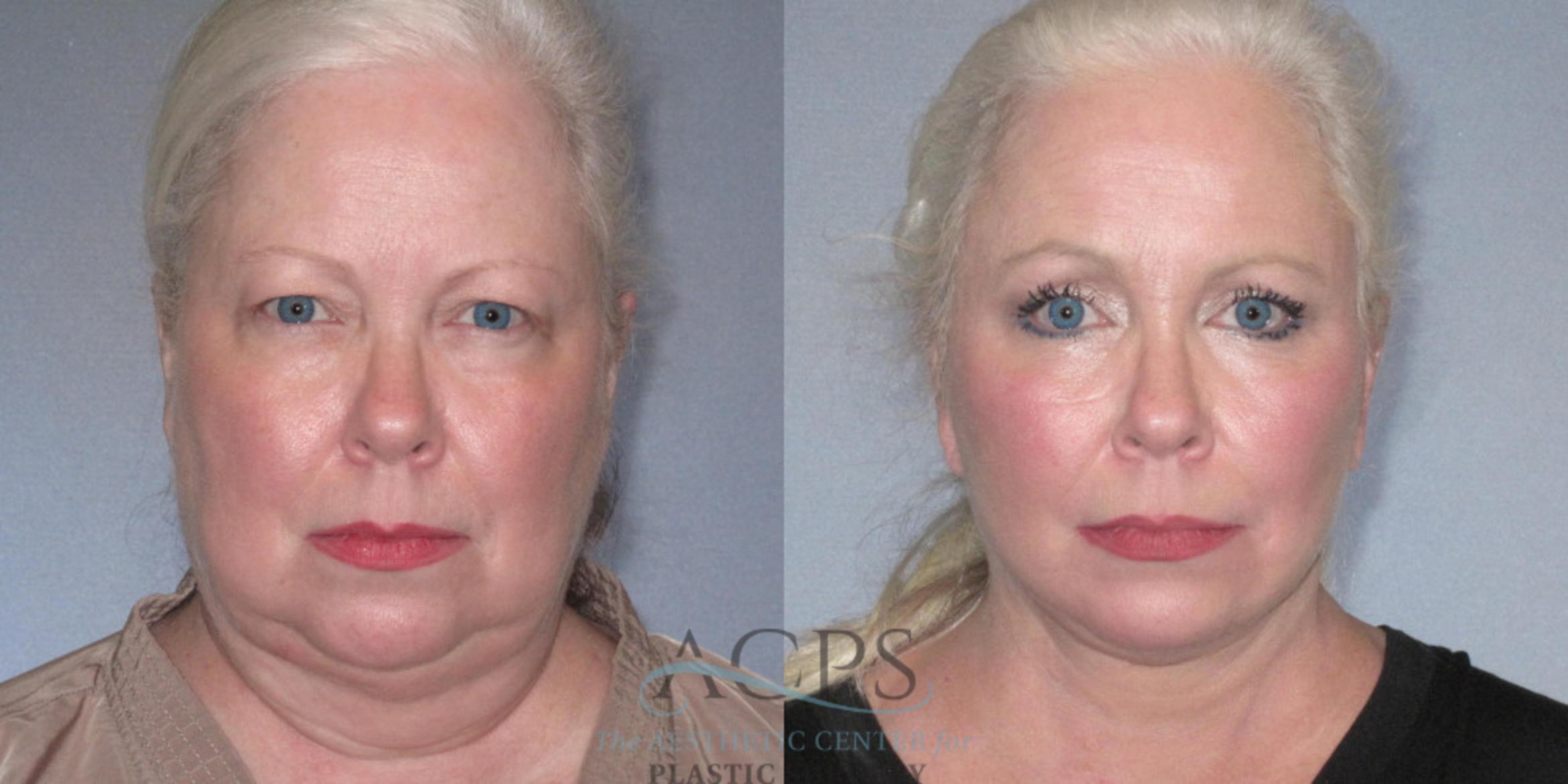 Before & After Facelift Case 1242 Front View: View in Houston, TX