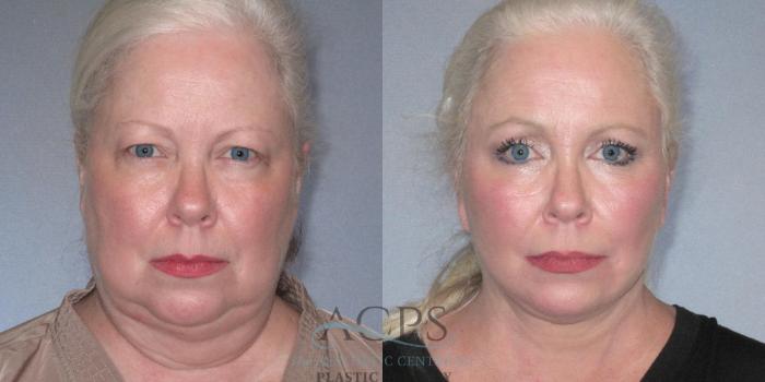 Before & After Facelift Case 1242 Front View: View in Houston, TX