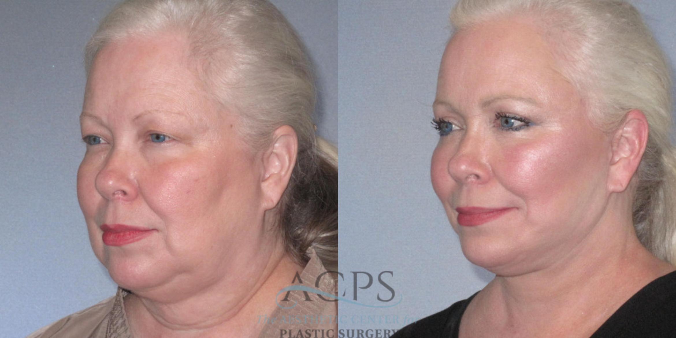 Before & After Facelift Case 1242 Oblique Left View: View in Houston, TX