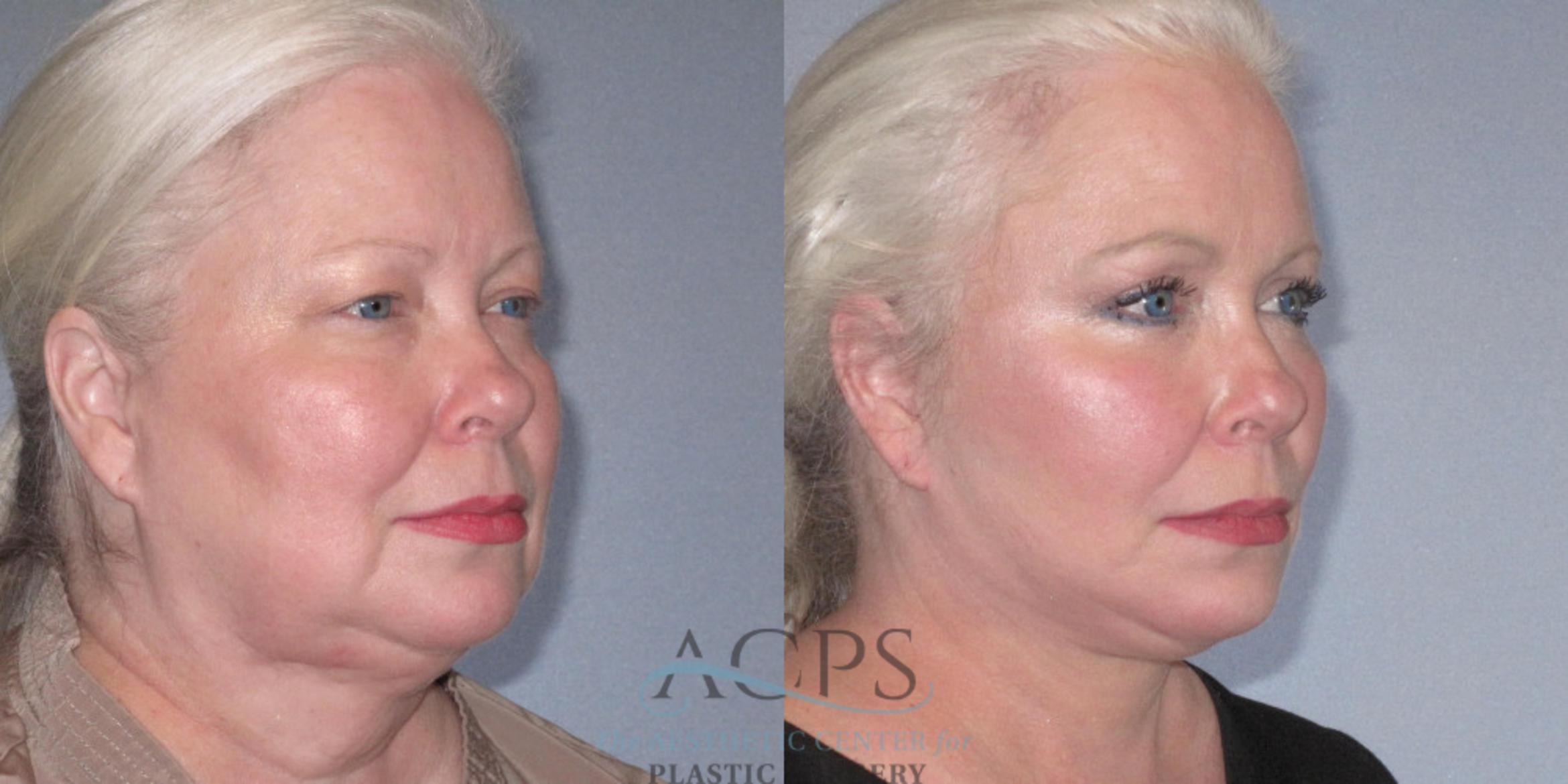 Before & After Facelift Case 1242 Oblique Right View: View in Houston, TX