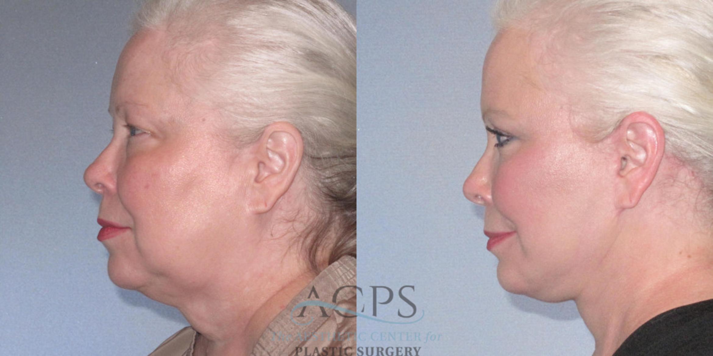 Before & After Facelift Case 1242 Side Left View: View in Houston, TX