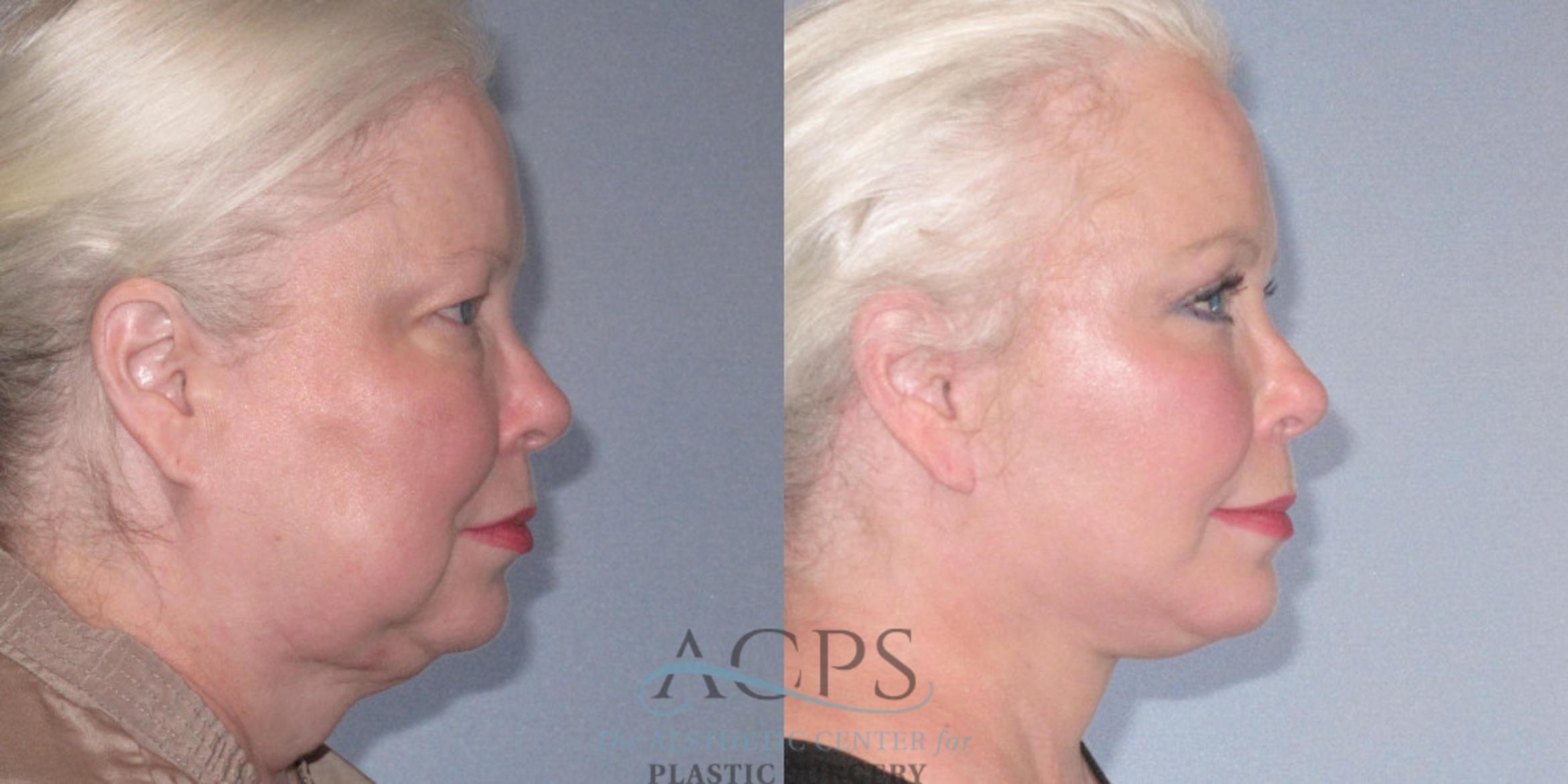 Before & After Facelift Case 1242 Side Right View: View in Houston, TX