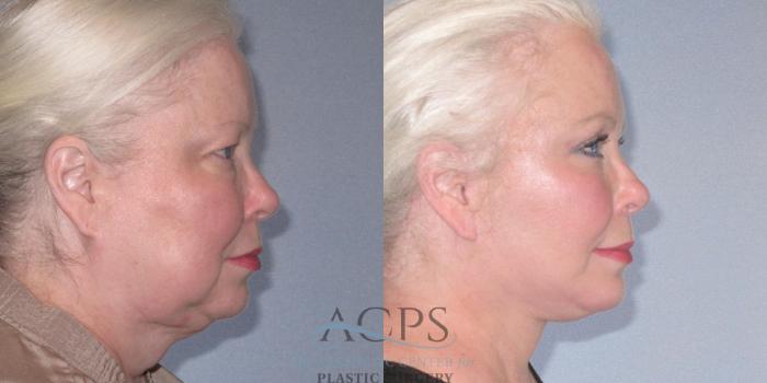 Before & After Facelift Case 1242 Side Right View: View in Houston, TX