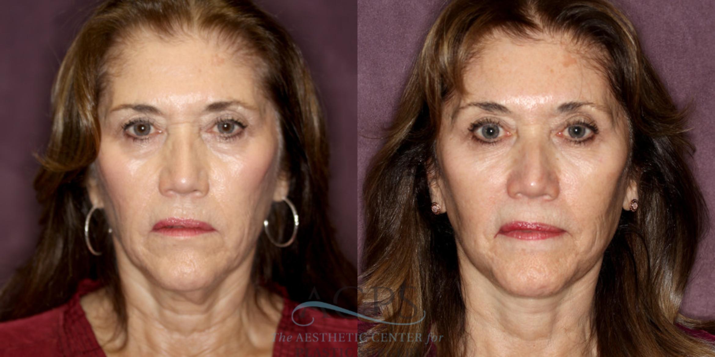 Before & After Neck Lift Case 1243 Front View: View in Houston, TX