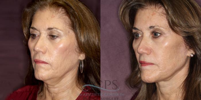 Before & After Neck Lift Case 1243 Oblique Left View: View in Houston, TX
