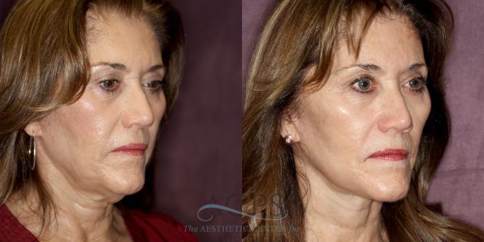 Before & After Neck Lift Case 1243 Oblique Right View: View in Houston, TX