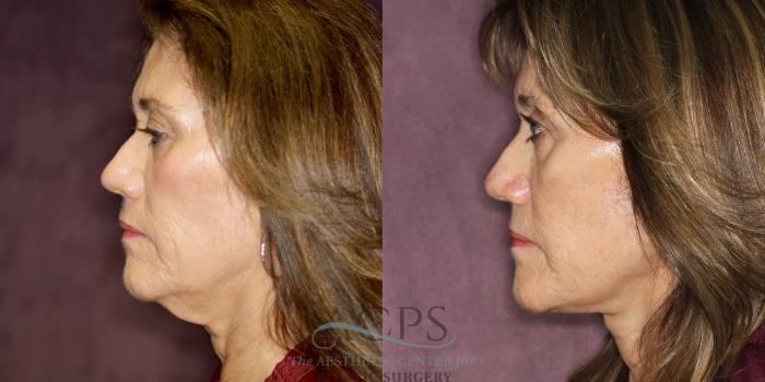 Before & After Neck Lift Case 1243 Side Left View: View in Houston, TX