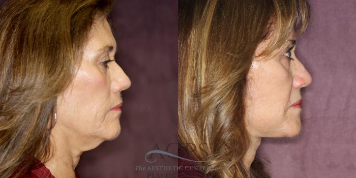 Before & After Neck Lift Case 1243 Side Right View: View in Houston, TX