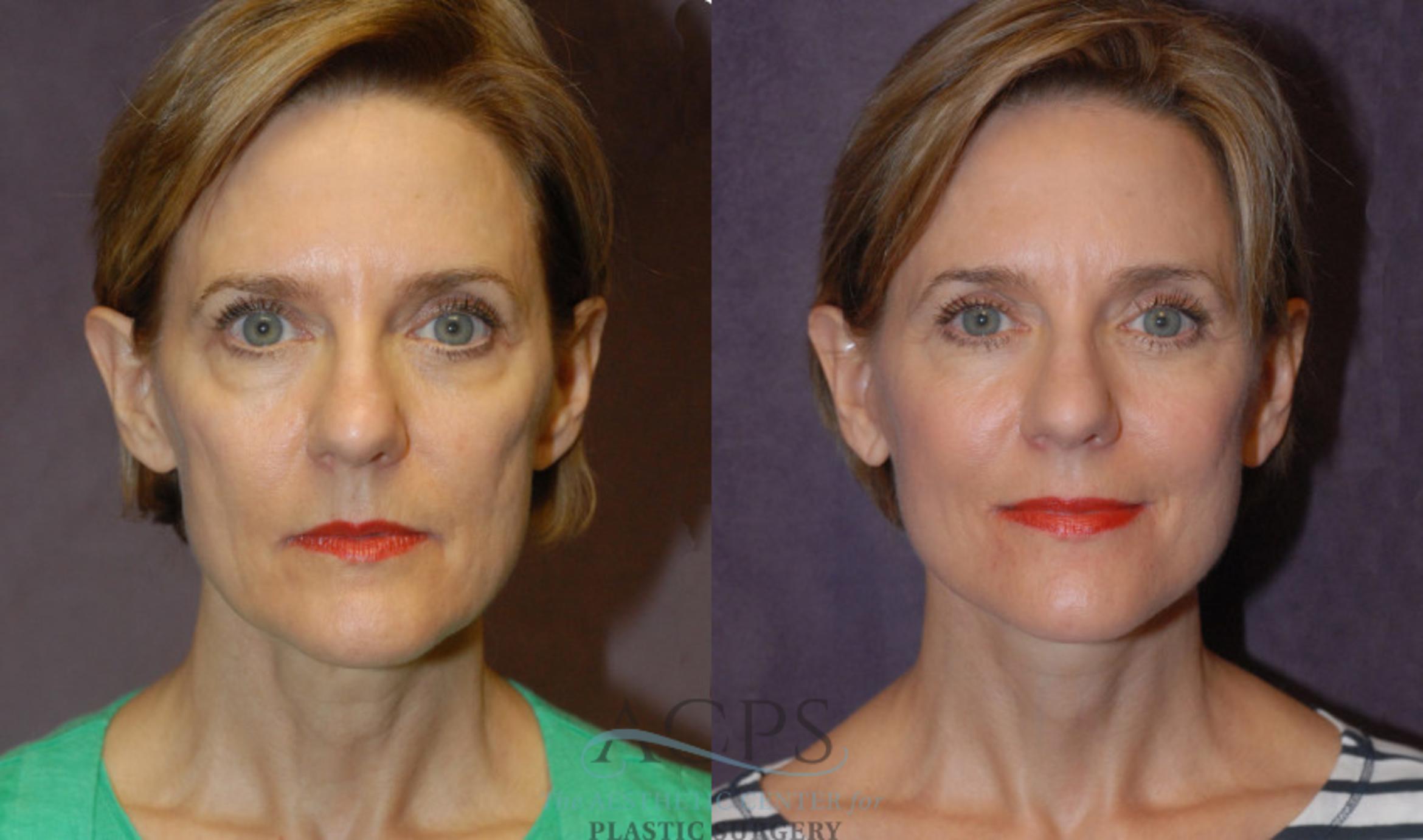 Before & After Facelift Case 1244 Front View: View in Houston, TX