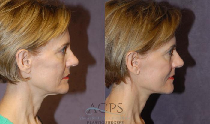 Before & After Facelift Case 1244 Side View: View in Houston, TX