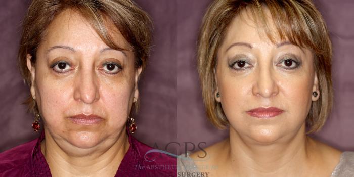 Before & After Facelift Case 1245 Front View: View in Houston, TX