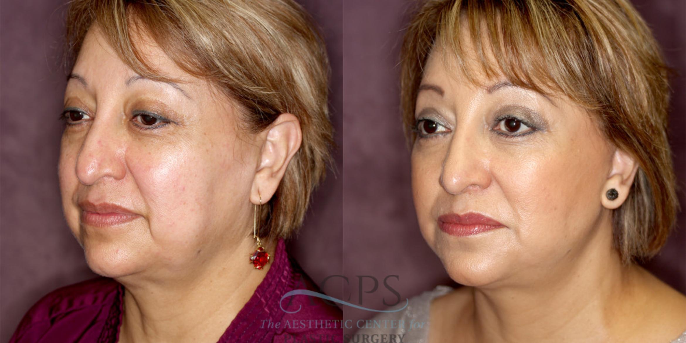 Before & After Facelift Case 1245 Oblique Left View: View in Houston, TX