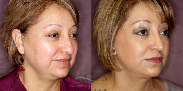 Before & After Facelift Case 1245 Oblique Right View: View in Houston, TX