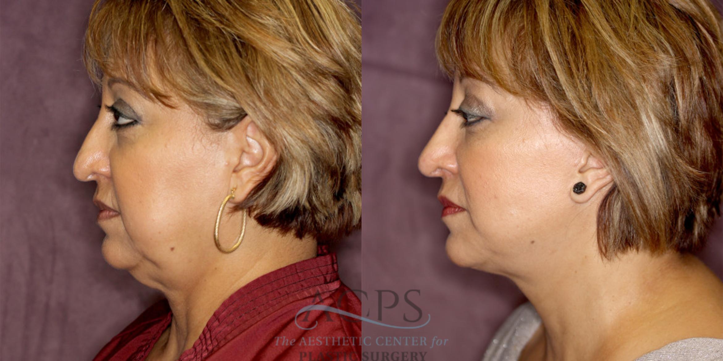 Before & After Facelift Case 1245 Side Left View: View in Houston, TX