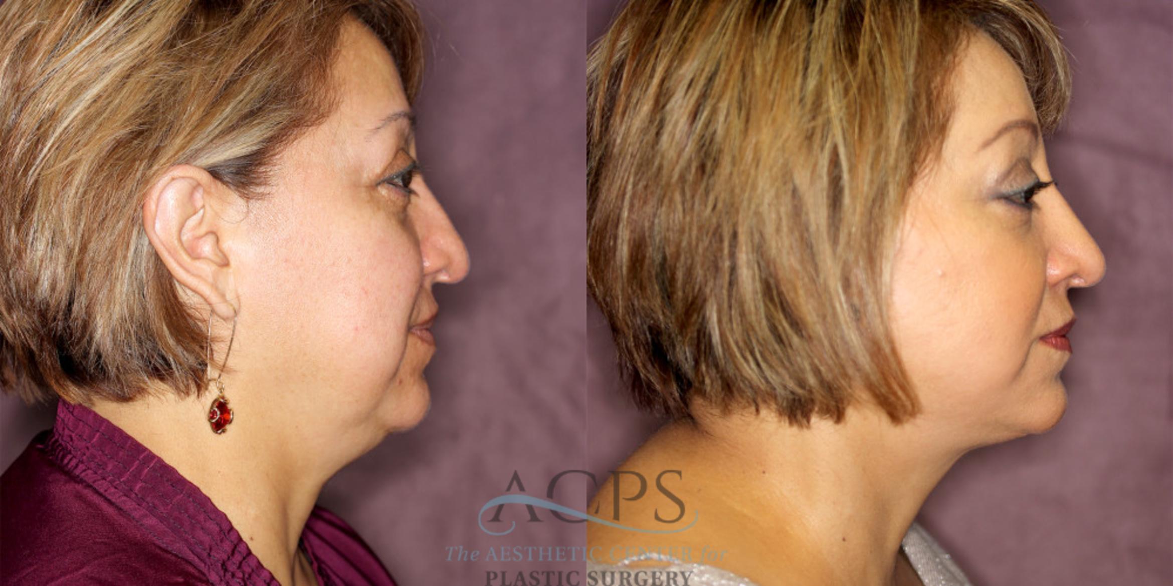 Before & After Facelift Case 1245 Side Right View: View in Houston, TX