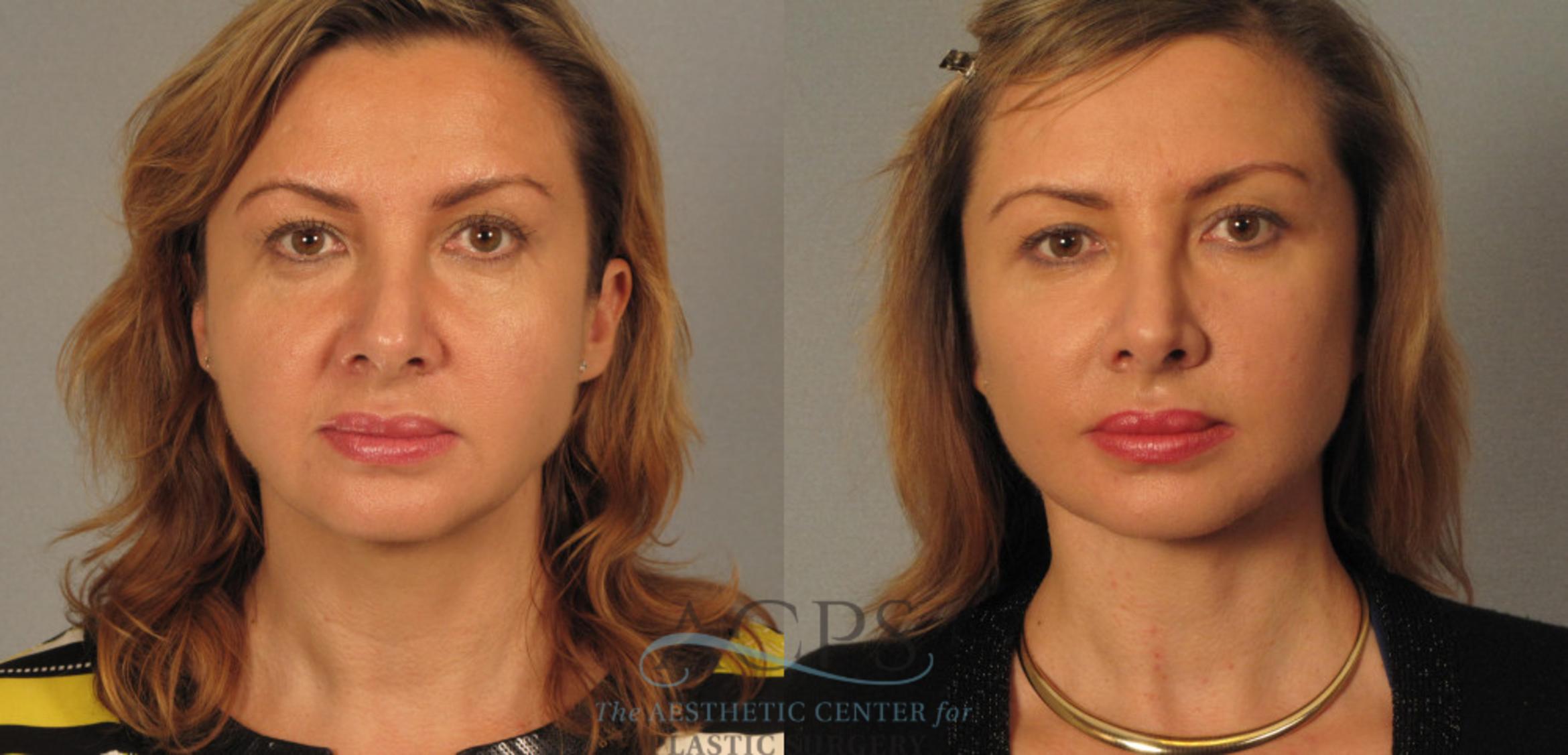 Before & After Facelift Case 1246 Front View: View in Houston, TX