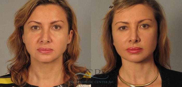 Before & After Facelift Case 1246 Front View: View in Houston, TX