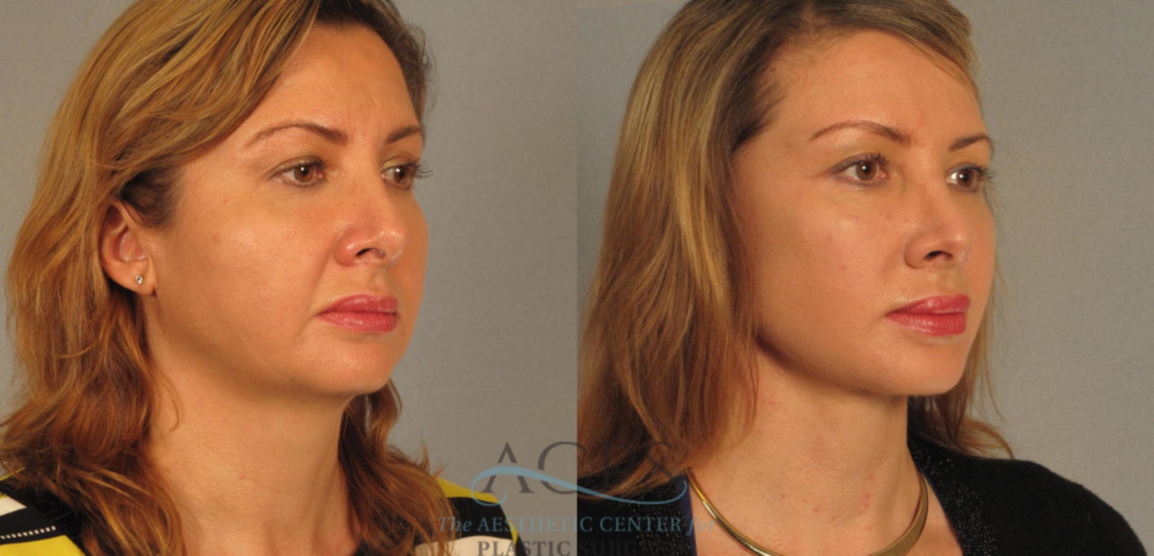Before & After Facelift Case 1246 Oblique View: View in Houston, TX