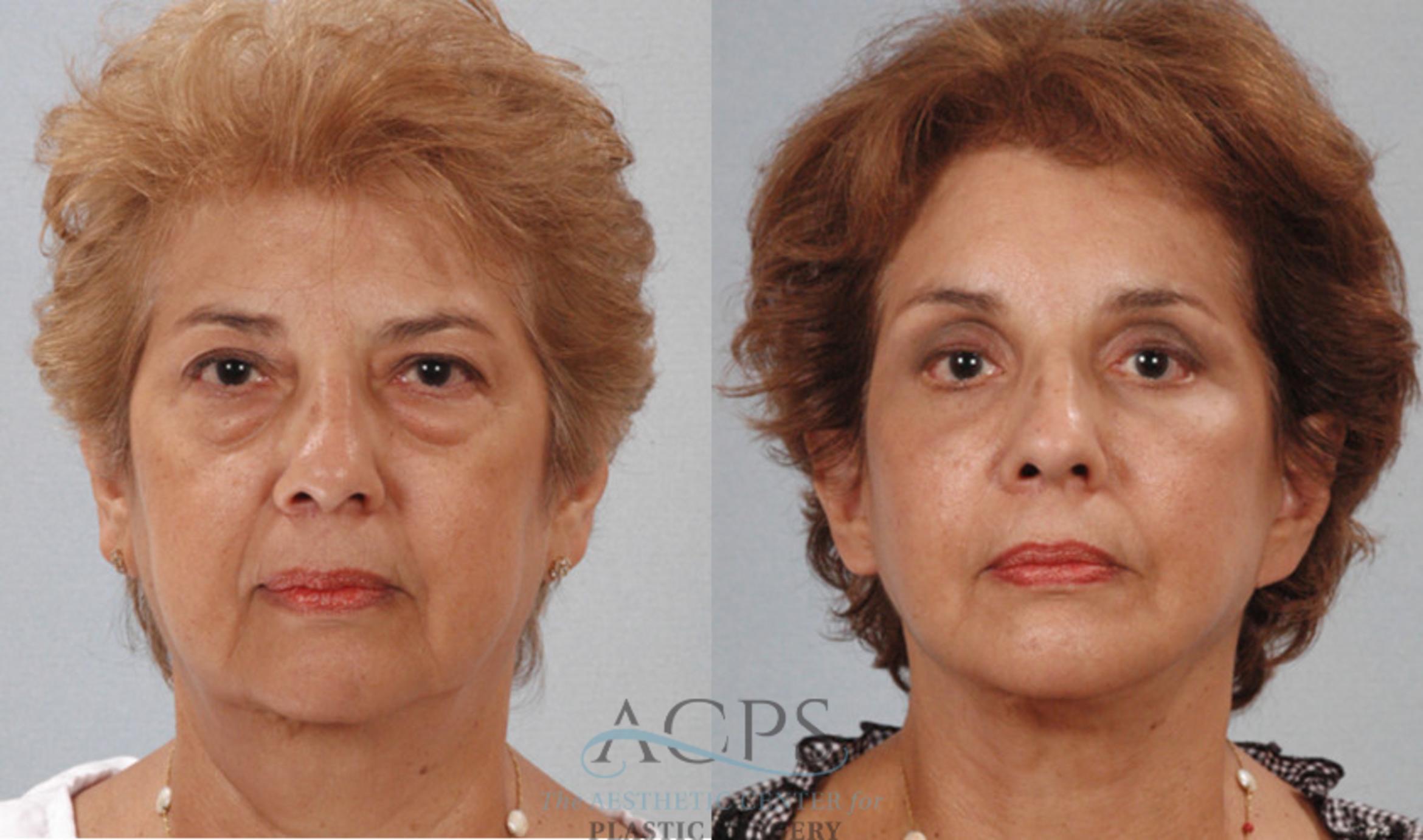 Before & After Facelift Case 1247 Front View: View in Houston, TX