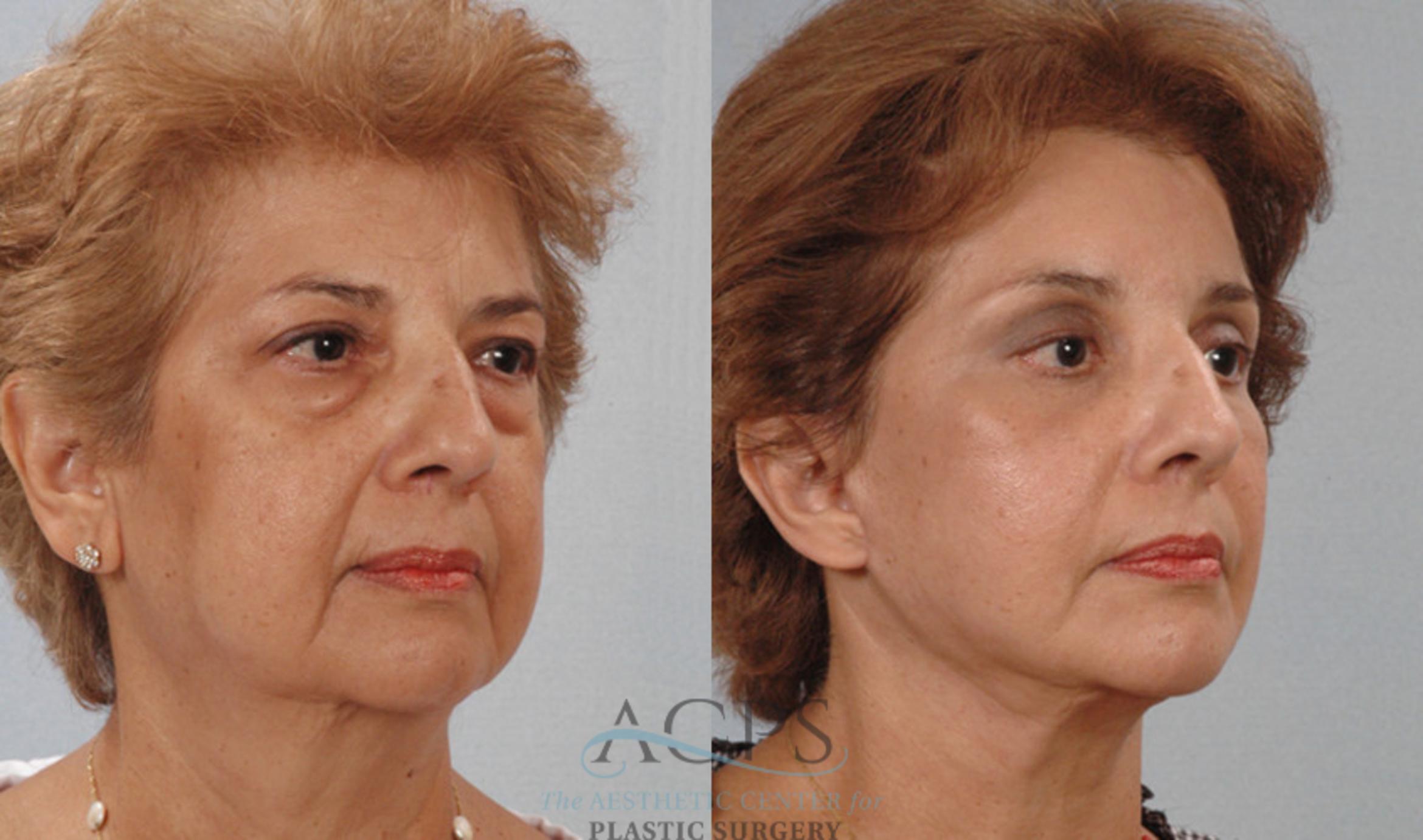 Before & After Facelift Case 1247 Oblique View: View in Houston, TX