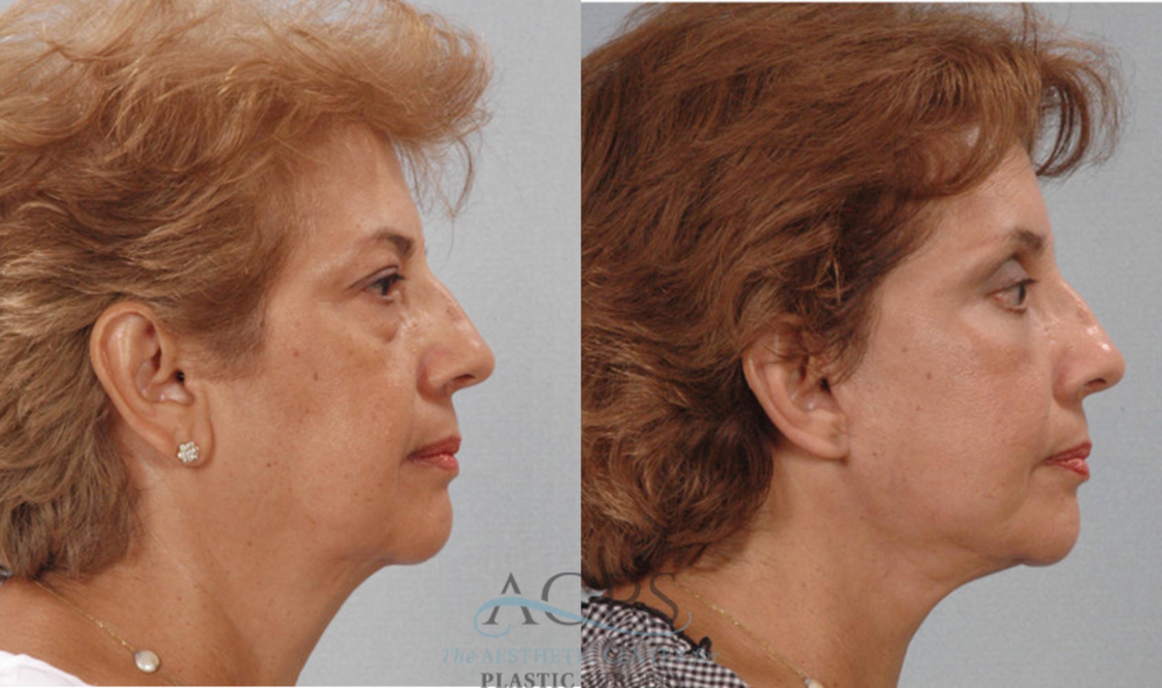 Before & After Facelift Case 1247 Side View: View in Houston, TX