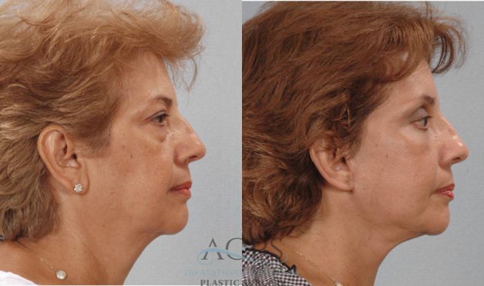Before & After Facelift Case 1247 Side View: View in Houston, TX