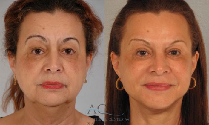 Before & After Facelift Case 1248 Front View: View in Houston, TX