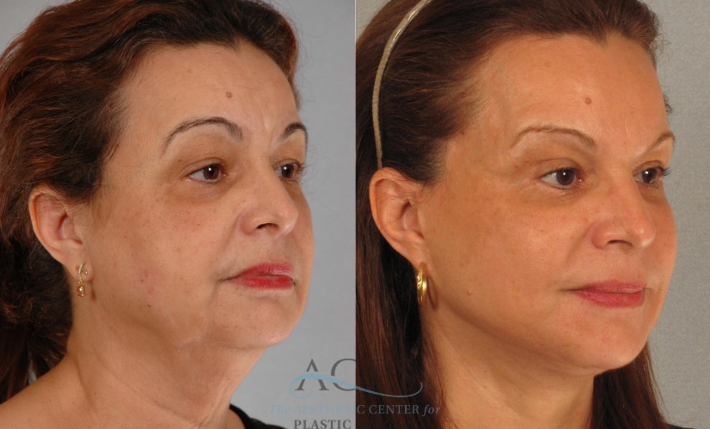 Before & After Facelift Case 1248 Oblique View: View in Houston, TX