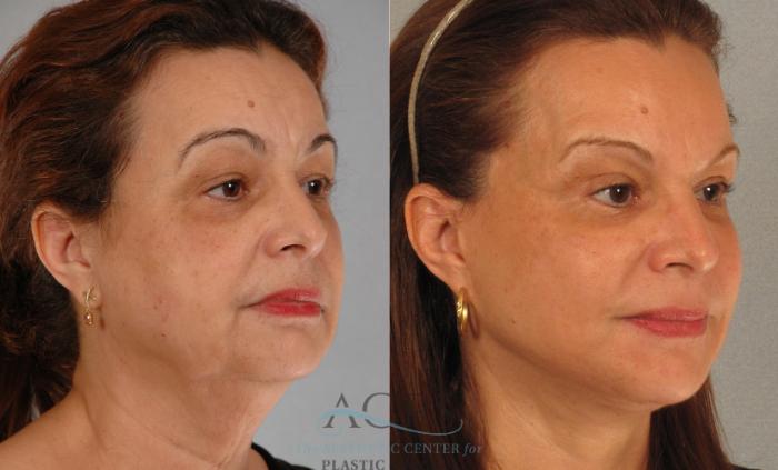 Before & After Facelift Case 1248 Oblique View: View in Houston, TX