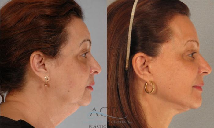 Before & After Facelift Case 1248 Side View: View in Houston, TX