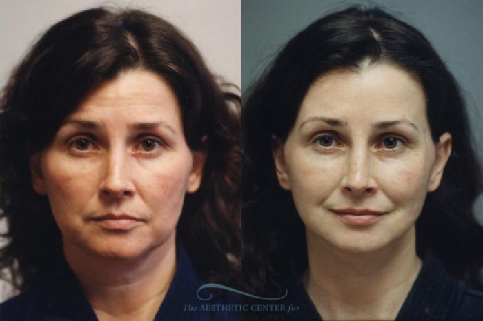 Before & After Facelift Case 1250 Front View: View in Houston, TX